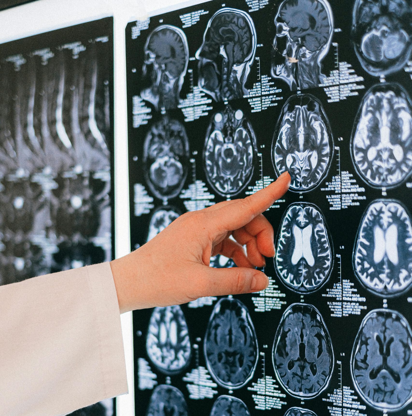 A doctor's hand points to a brain MRI scan on a lightbox, illustrating medical diagnosis.